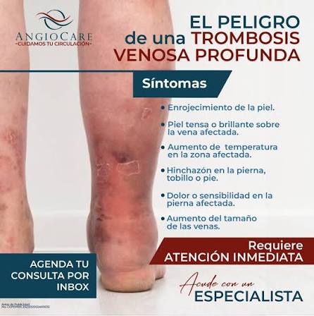 ❗Conoce el peligro de una Trombosis Venosa Profunda❗ 👉La Trombosis Venosa  Profunda (TVP) es grave porque los coágulos pueden desprenderse y alojarse  en los pulmones. 👉Es una afección que sucede cuando se