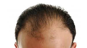 In this article we provide simple and best treatments for frontal hair loss control. Does Minoxidil Rogaine Work For Frontal Baldness Ds Healthcare Group