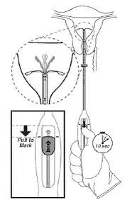 These medical abbreviations are commonly used in hospital, medical, and dental records. Mirena Levonorgestrel Releasing Iud For Birth Control Uses Dosage Side Effects Interactions Warnings