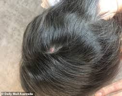 This includes trichotillomania and hair pulling conditions along this spectrum. Trichotillomania Australian Women Reveal The Reality Of Living With Hair Pulling Disorder Daily Mail Online