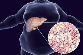 Advanced liver conditions include liver cancer and cirrhosis, severe liver cell damage in which healthy liver tissue is replaced by scar tissue. Low Carb As A Treatment For Fatty Liver Diet Doctor