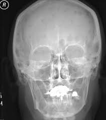 Image result for Skull XRay