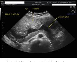 Image result for Retained Placenta