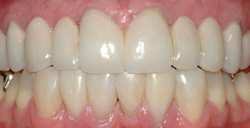 Although having a tooth pulled is usually very safe, the procedure can allow harmful bacteria into the bloodstream. What You Should Know Before You Get An Extraction And Why You Should Consider Bone Grafting