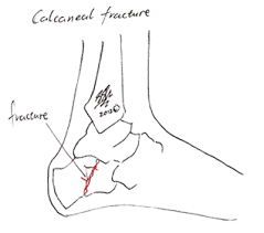 Image result for Calcaneus Compression Fracture