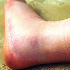 See full list on mayoclinic.org Different Types Of Fractures Signs And Pictures