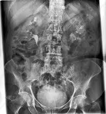 Duplex Kidney Collecting System X Ray Stock Image C017 7973 Science Photo Library