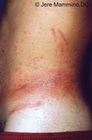 No matter how long it takes for the rash to appear, most people experience the following when they get a rash: Poison Ivy Dermatitis American Osteopathic College Of Dermatology Aocd