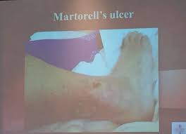 We did not find results for: Ido Weinberg Md On Twitter Painful Ulcer In A Hypertensive Patient Raghukollurimd Showed This Hypertensive Martorell S Ulcer At Svm2015 Http T Co Faulp3kzim