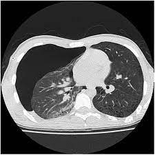 There are several different ways to classify and name pneumothoraces. Recurrent Pneumothoraces In A 17 Year Old Man With Mixed Connective Tissue Disease Thorax