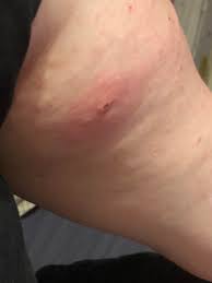Image result for wolf spider bite skin