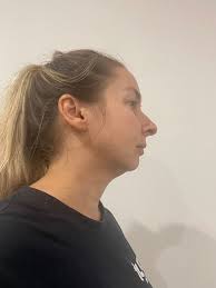 Face-lift & Neck-lift Support Group