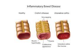 IBD: What is IBD? | IBDrelief