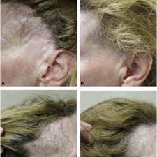 Finasteride is a great medication for androgenic alopecia, and it has shown its ability to help slow down the rate of hair loss and maintain the current hair that you have. Pdf Finasteride Mediated Hair Regrowth And Reversal Of Atrophy In A Patient With Frontal Fibrosing Alopecia
