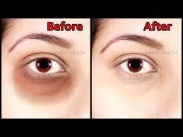 Get Rid Of Under Eye Dark Circle Puffiness Fine Lines In 1 Week Magical Eye Mask Youtube Undereye Dark Circles Dark Circles Under Eyes