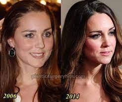 Aug 02, 2021 · rund um das thema beauty: Kate Middleton Sparks Plastic Surgery Kate Middleton Princess Katherine Kate And Meghan