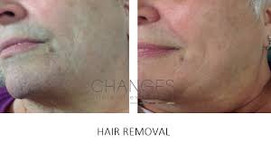 The treatment of genetalia varies greatly. Laser Hair Removal Ipl Hair Removal In Hampshire Changes Clinic