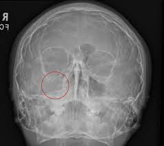 Image result for Sinus X Ray