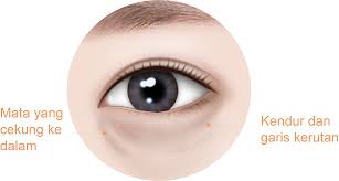 Penataan Ulang Lemak Di Bawah Mata Ganda Braun Plastic Surgery