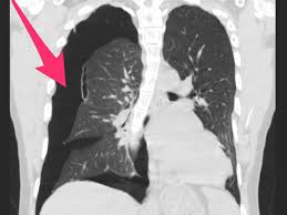 The pain is made worse by breathing in; Photos Show Vaping Lung Damage Like Blisters And Lung Collapse