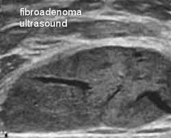 Ultrasound Of Hypoechoic Mass Or A Solid Breast Lump With Moose And Doc
