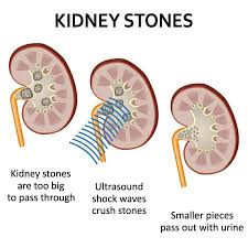 21 home remedies for kidney stones. How Is Kidney Stone Treated By Dr Satyajeet P Pattnaik Lybrate