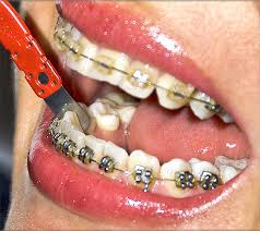 A helpful tool called a floss threader can make it easier to get the floss behind your braces. An Evolution In Dental Flossing Is Here No Strings Attached