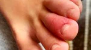 If rainy season is coming, spray some protective neem oil to keep the from another perspective, the orange spots may be a protective measure that occurs naturally to slow down the growth of the dragon fruit a bit. Toes And Fingers Can Show Covid 19 Symptoms Dermatologist Says Wpec