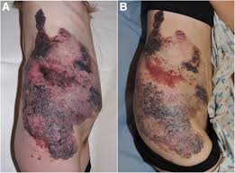 Image result for Sirolimus