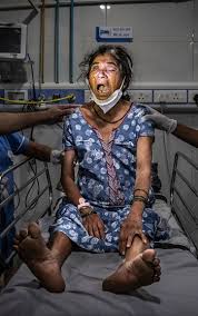 Unfortunately, the black community is lagging behind in covid vaccination and as a result, is experiencing higher rates of. Inside India S Black Fungus Wards Delta Variant Linked To Hundreds Of Deaths From Mucormycosis