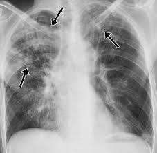 Tuberculosis without established localization the greatest difficulties arise at diagnosing tubercular intoxication and small formsof lymphatic nodes. Pulmonary Tuberculosis Role Of Radiology In Diagnosis And Management Radiographics