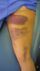 Hamstring strains often occur from fast sprinting and kicking movements as the muscle tries to arrest the movement of the lower leg as it dynamically travels away from the body. Hamstring Tears 321gomd