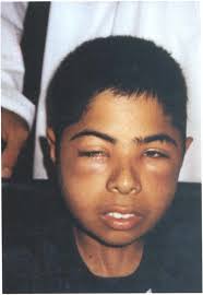 Orbital involvement in sickle cell disease: a report of five cases and  review literature