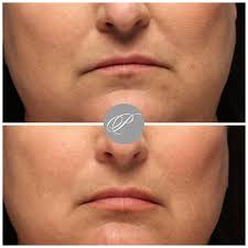 Guys love curves, and her lips are curved just so, and they're so kissable…and if it's at a tim. Skinmedica Ha5 Lip System Skin Medica Lips Lip Treatment