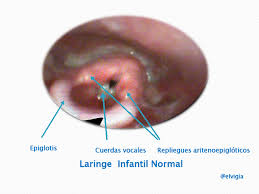 It happens when a baby's larynx (or voice box) is soft and floppy. Laringomalacia Consideraciones Clinicas Y Manejo Steemit