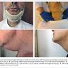 You should also consider medical help if you were previously treated for an infection, and you have a swollen lymph node in the neck. 1