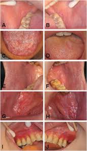 Image result for lichen planus on tongue)