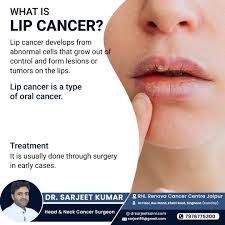 Image result for Lip Cancer