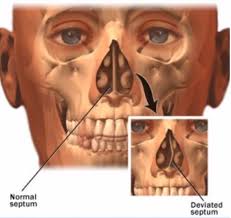 I have blue cross blue shield for insurance and was curious if anyone knows if this would be covered? Septal Reconstruction In Los Angeles Septum Reconstruction