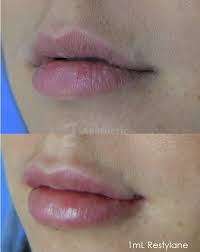 Welcome to radiance medical aesthetics & wellness, the #1 medical spa in the woodlands. Lip Injections Orlando Fl High Quality Lip Fillers Aesthetic Lane