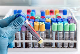 This bipolar spectrum test is delivered to you free of charge and will allow you to obtain your scores related to elevated energy, elevated mood, depressive episodes, hyperactivity, alcohol/drug use, anxiety, irritability, impulsivity, racing thoughts, and pressured speech. Scientists Create Blood Test For Depression And Bipolar Disorder