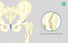 Some early cancers may have signs and symptoms that can be noticed, but that's not always the case. Bone Cancer Symptoms Causes Treatment Medicine Prevention Diagnosis