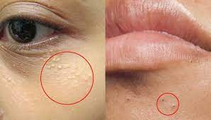 Este tipo de grano en la piel suele encontrarse en zonas del rostro como los párpados, pómulos, mandíbula y parte posterior de las orejas. Fotos 4 Tipos De Granos Que No Deberias Apretar O Rascar Nunca En Tu Vida Que Pasa Salta