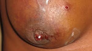 Unlike other types of breast cancer in which surgery is the first modality of treatment, chemotherapy before surgery or radiation therapy is the current standard. 7 Pictures Of Breast Cancer