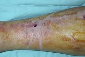 Most wounds will heal naturally with time, however, there are some things a person can do to speed up the healing process. Open Fractures Orthoinfo Aaos