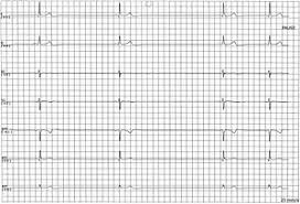Sinus Node Dysfunction Wikipedia