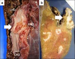 This makes ovarian cancer a potentially isolating and very scary disease. Metastasis Of Ovarian Cancer To The Bile Duct A Case Report Surgical Case Reports Full Text
