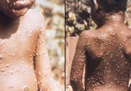 Monkeypox cases rise with few vaccines and a new outbreak emerges in  Florida | WPEC