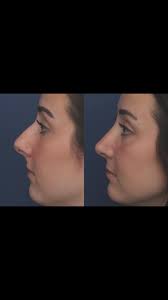 gyno #gynosurgery #correctionofgyno #gynecomastua Believe it or not I have  a special interest in helping guys with gyno. I use advanced techniques to  get them the most natural results. Guys hate gyno.