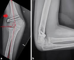 Image result for Lateral Condyle Fracture